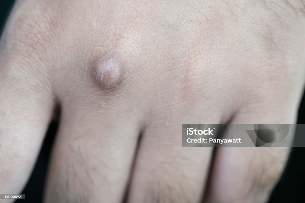 Preventing Recurrence: Tips After Ganglion Cyst Treatment